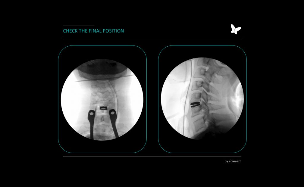 ניתוח-להחלפת-דיסק-צווארי ד״ר תאי פריזם